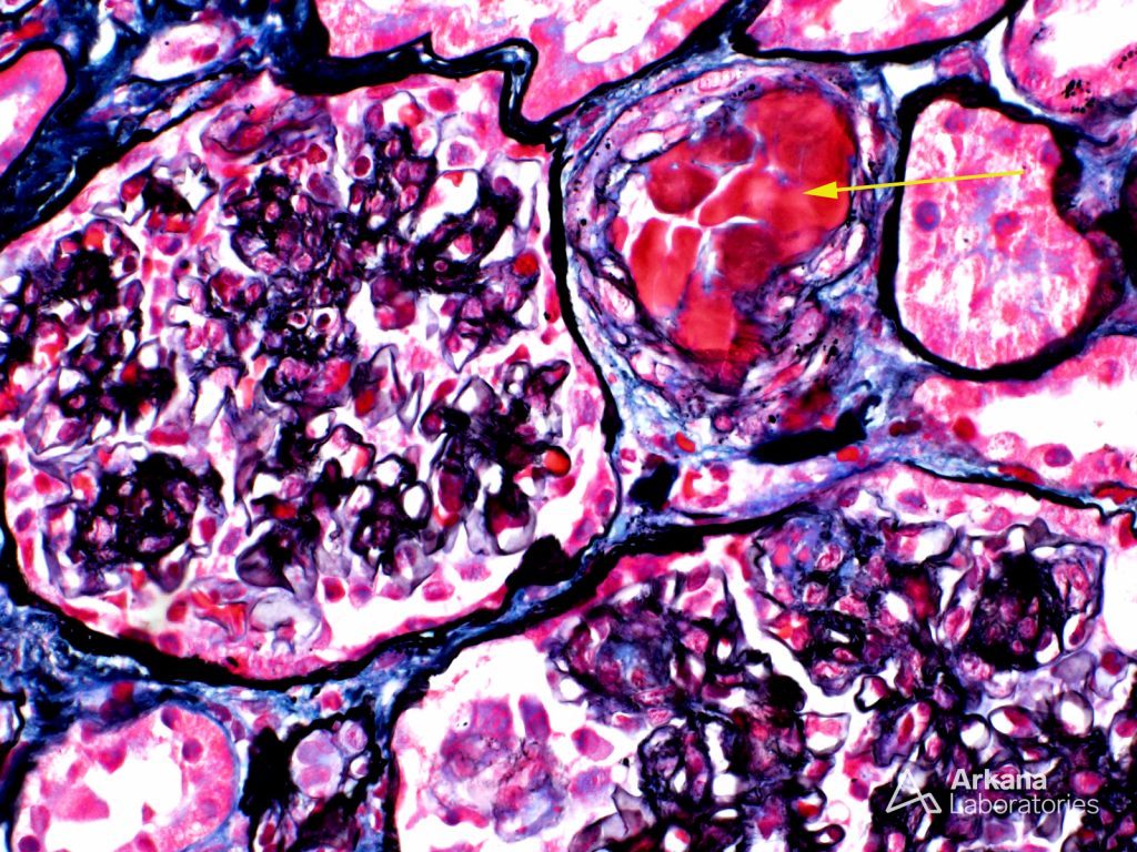 Waldenstrom Macroglobulinemia | Teaching Points | Arkana Laboratories