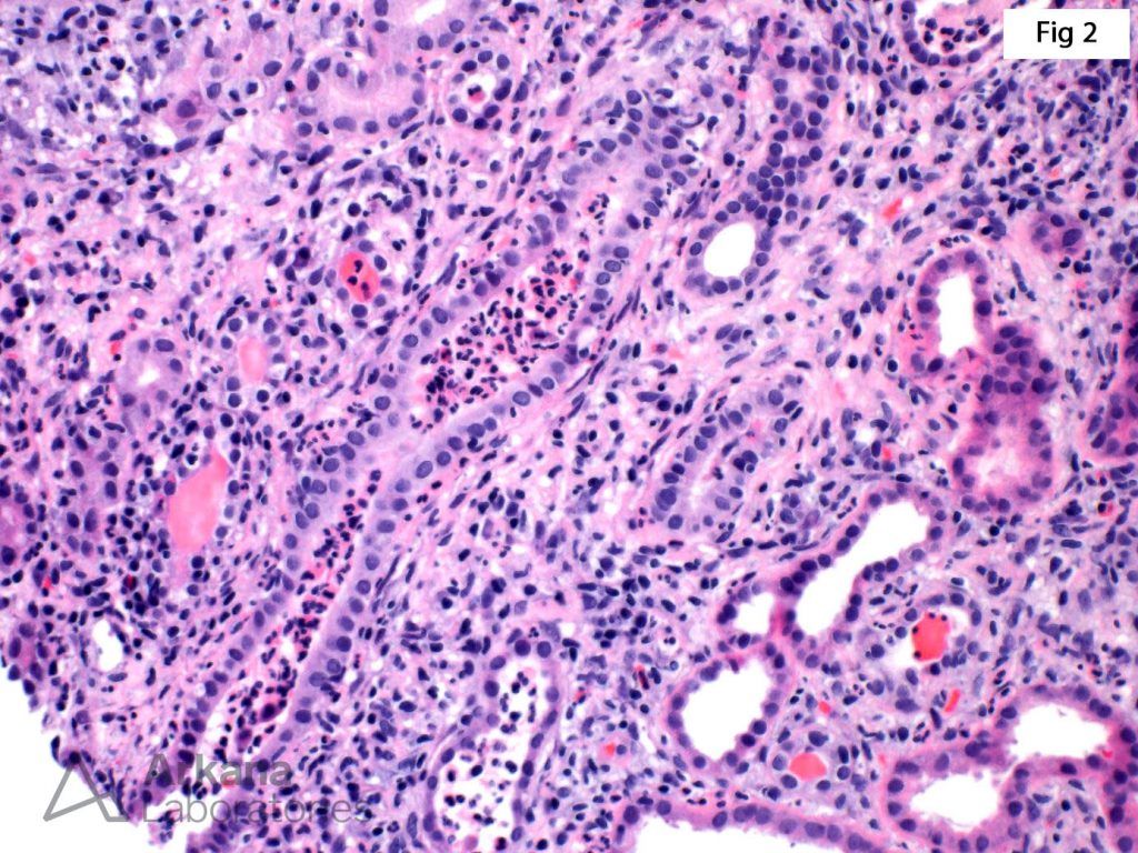 Chronic Active Tubulointerstitial Nephritis | Teaching Points | Arkana Labs