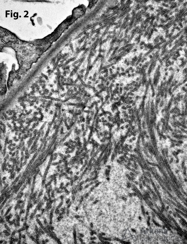 Immunotactoid Glomerulopathy 