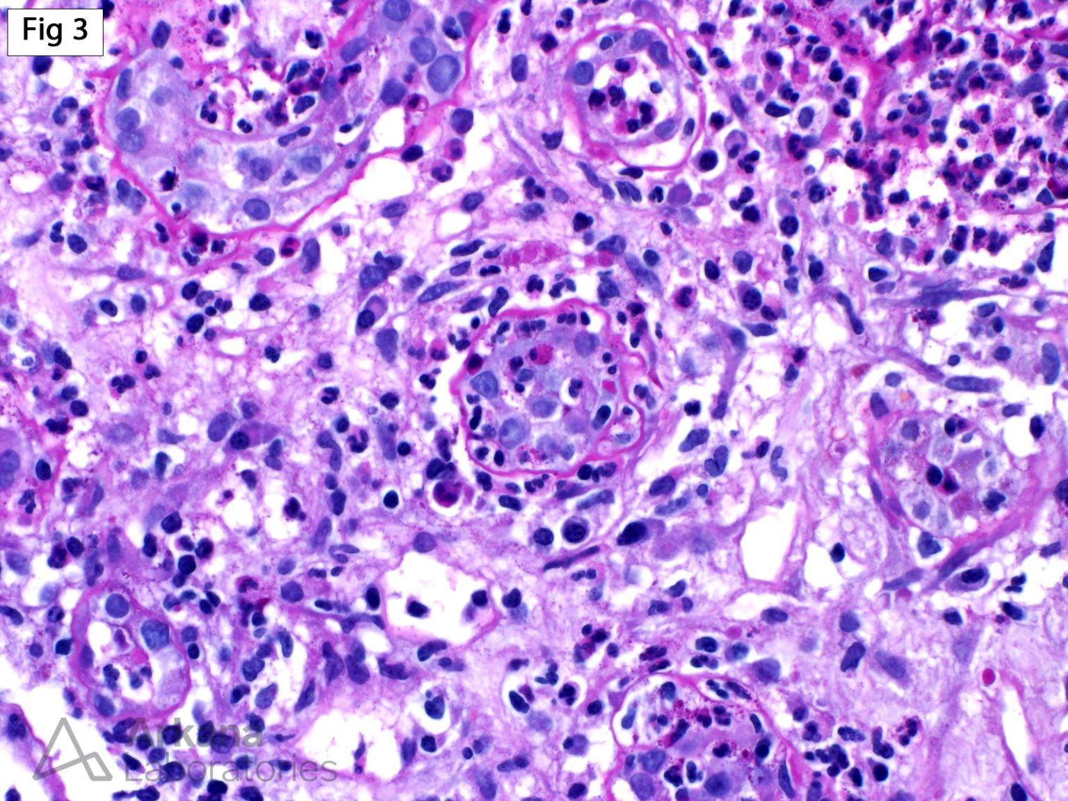 Acute Pyelonephritis Teaching Points Arkana Laboratories