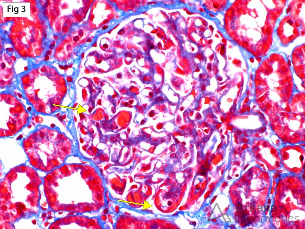 Immune Deposits in SLE | Teaching Points | Arkana Laboratories