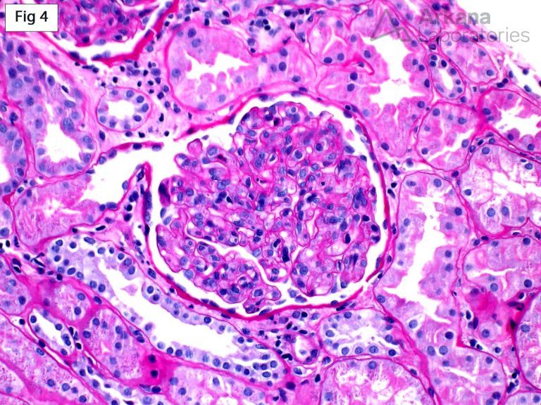 Thrombotic Microangiopathy | Teaching Points | Arkana Laboratories