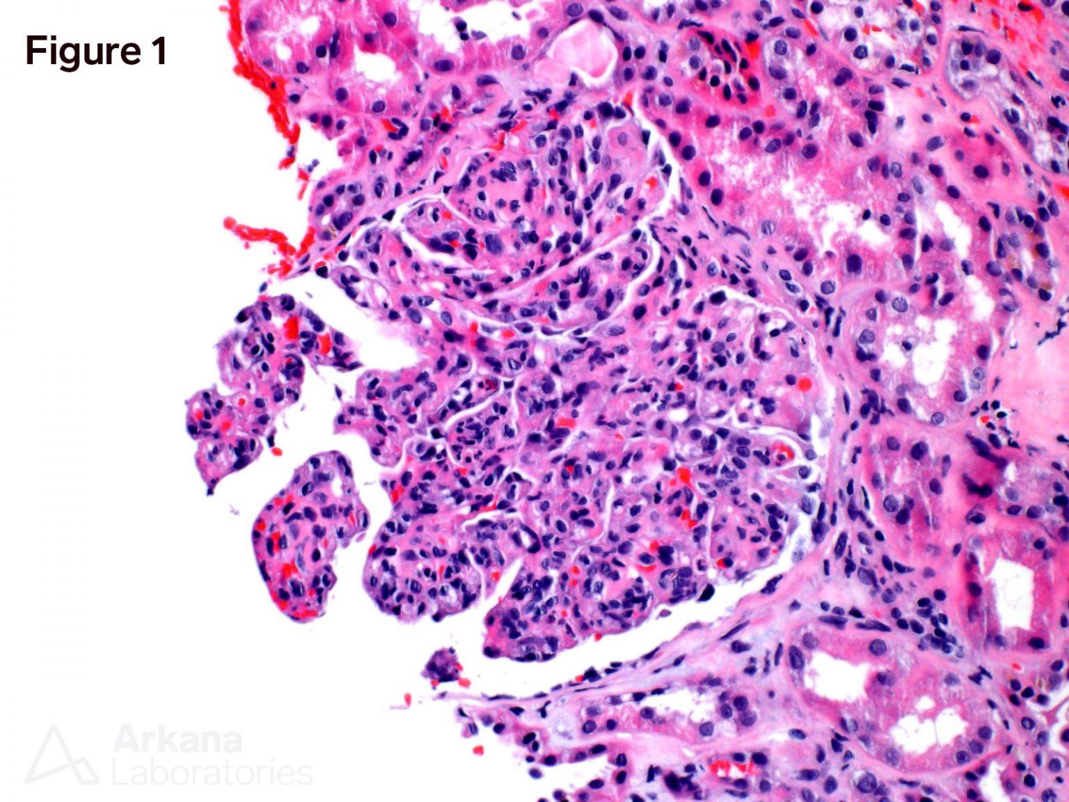 Cryoglobulinemic Glomerulonephritis | Teaching Point | Arkana Labs