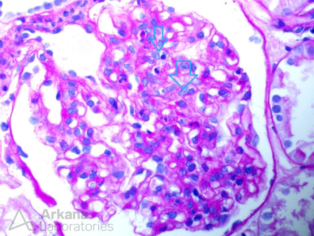 Infection-Associated Glomerulonephritis | Teaching Point | Arkana Labs