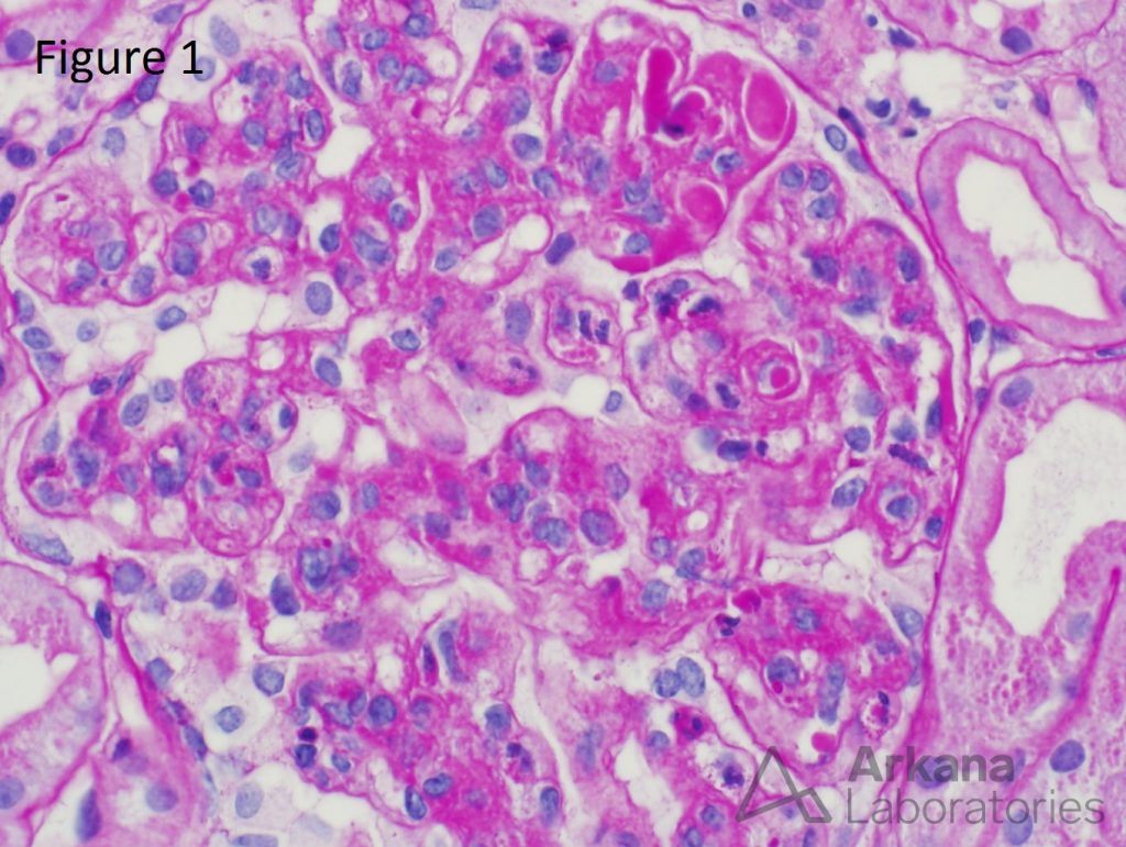 Hyaline thrombi Archives - Arkana Laboratories