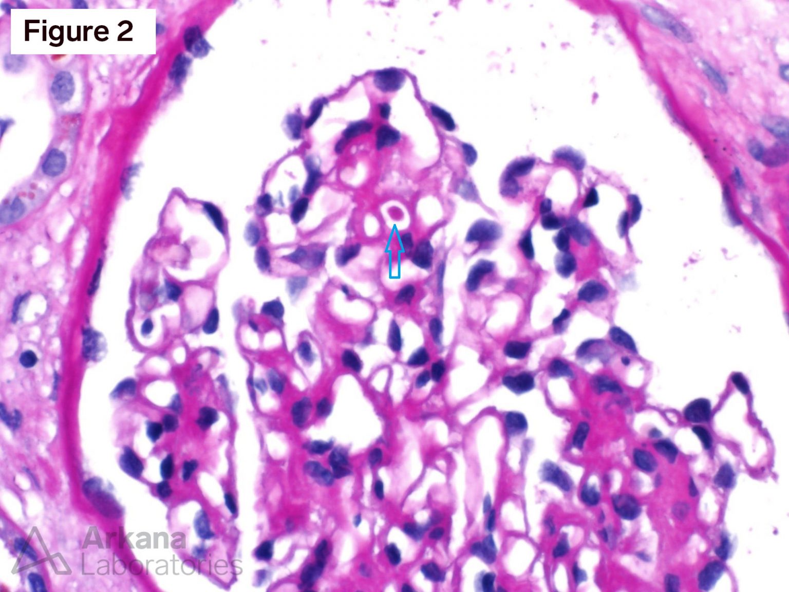 Cryoglobulinemic Glomerulonephritis | Teaching Point | Arkana Labs