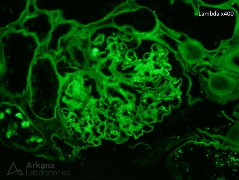 IgA Dominant Infection-Associated Glomerulonephritis | Arkana Labs