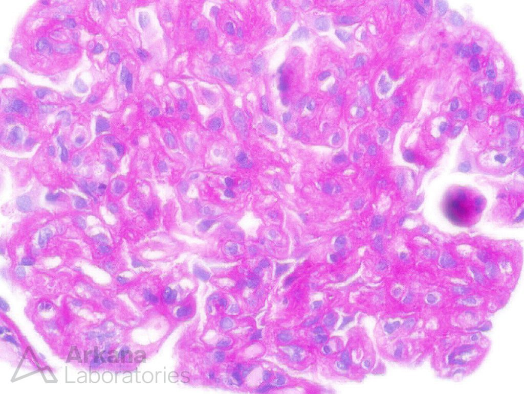 Hyaline thrombi Archives - Arkana Laboratories