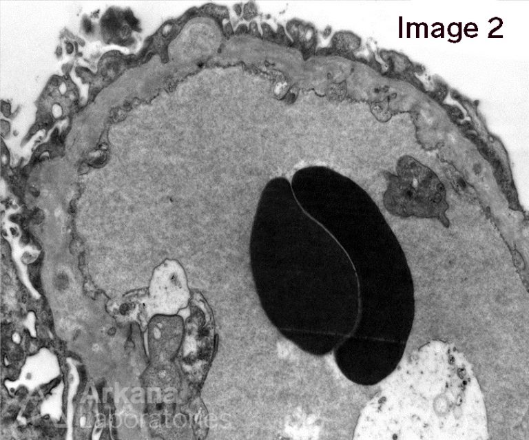 Membranous Nephropathy Teaching Point Arkana Laboratories