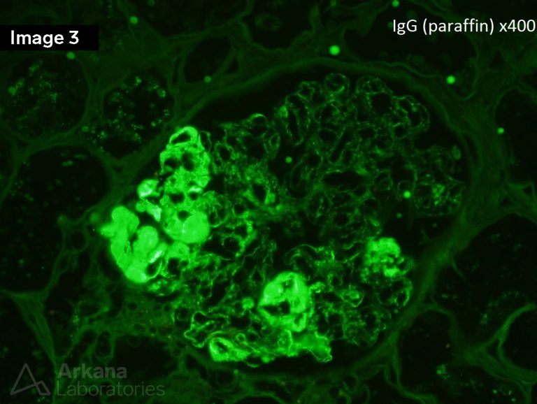 Type 1 Cryoglobulins Teaching Point Arkana Laboratories