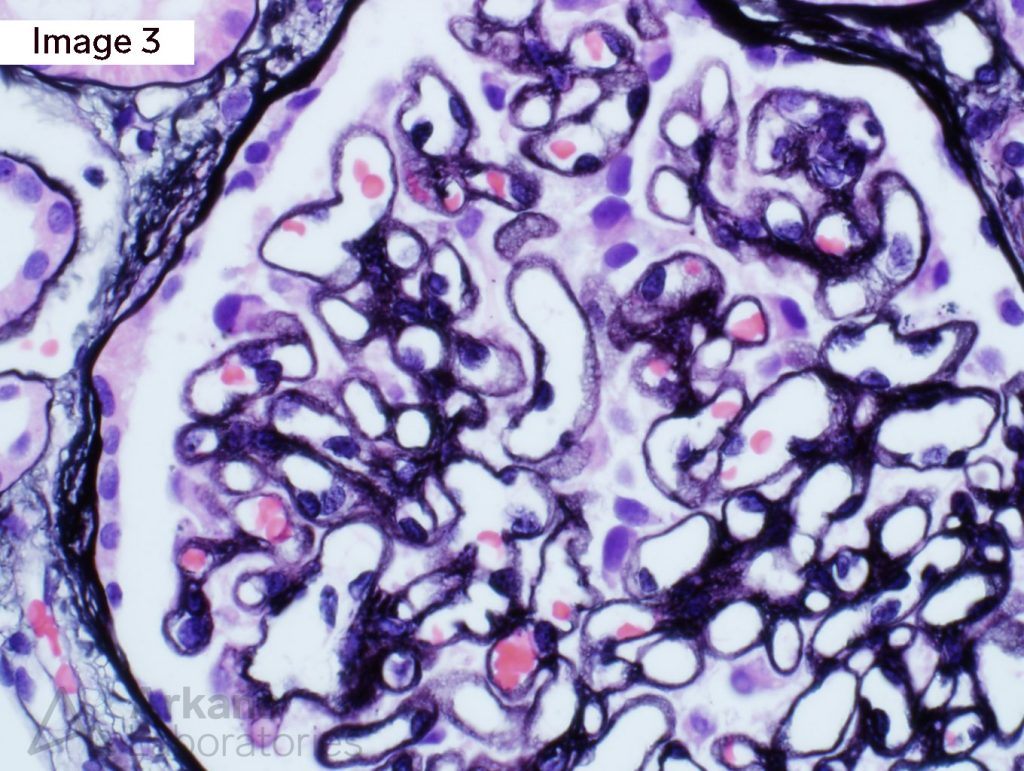 membranous-nephropathy-teaching-point-arkana-laboratories