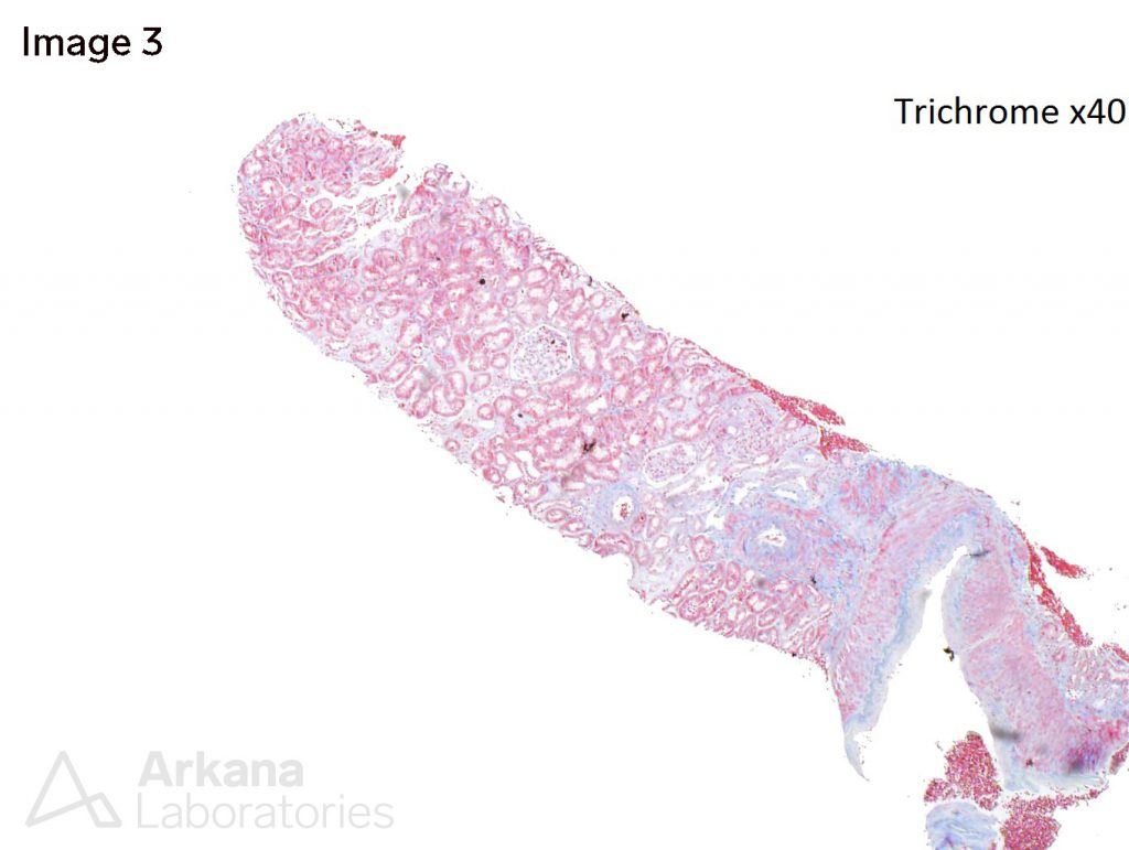 Alect2 Amyloidosis Teaching Point Arkana Laboratories 3685