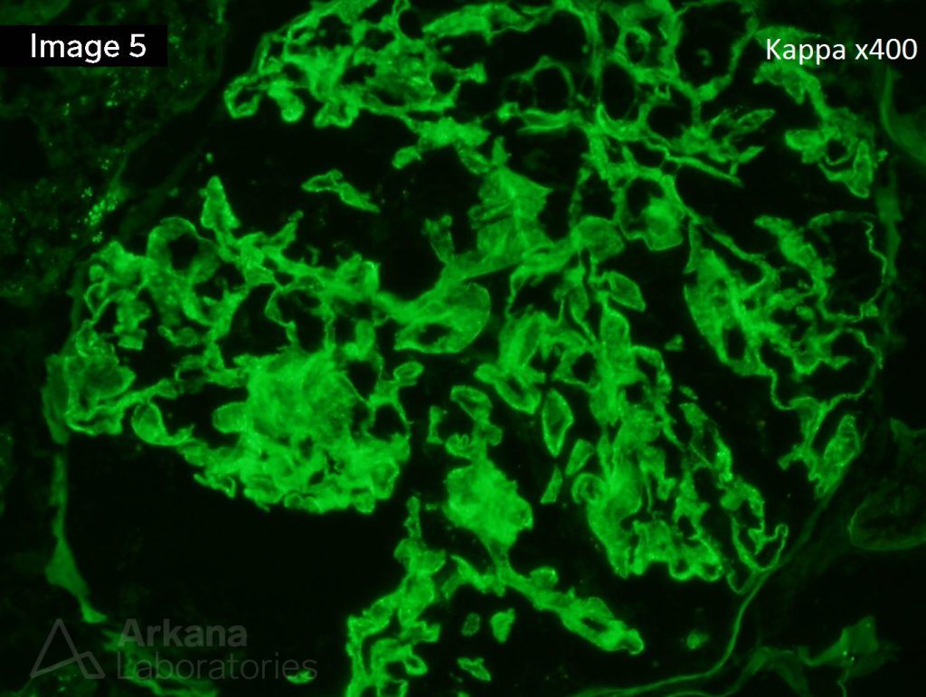 Membranous Nephropathy Teaching Point Arkana Laboratories