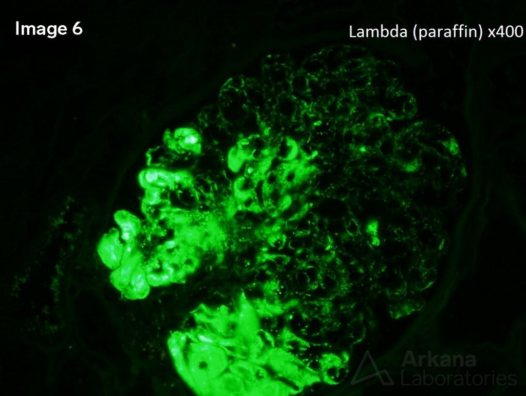 Type 1 Cryoglobulins Teaching Point Arkana Laboratories