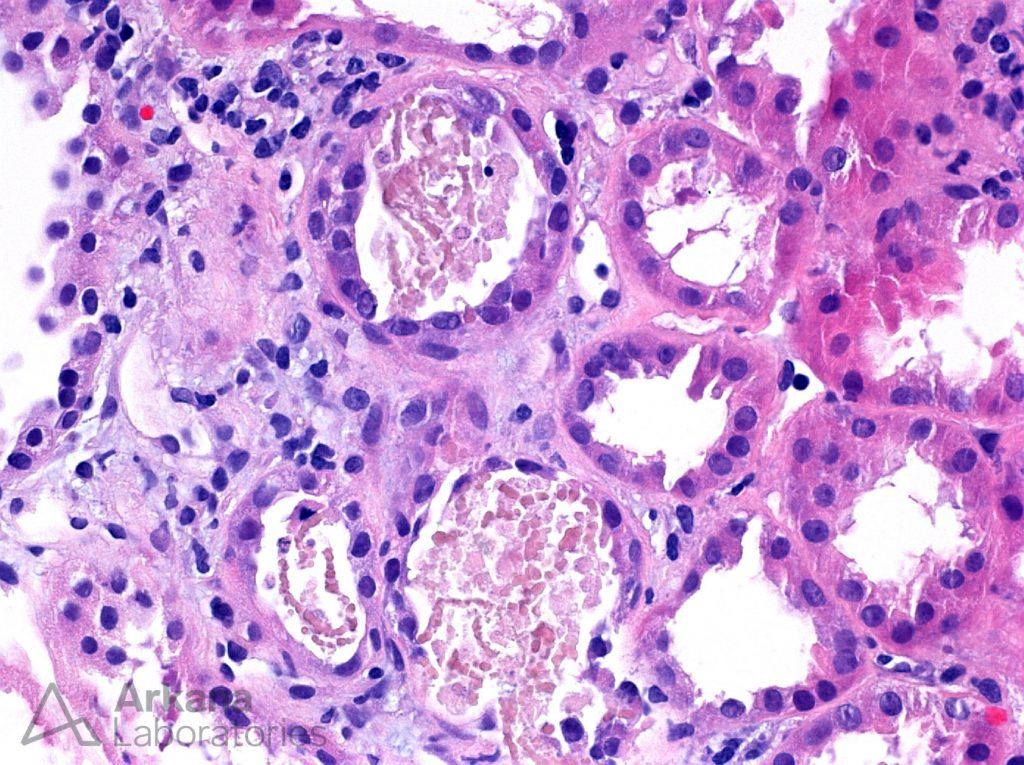 Myoglobin Casts | Diagnose This! | Arkana Laboratories