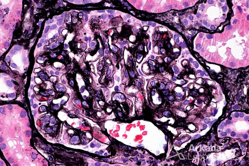 monoclonal-gammopathy-of-renal-significance-teaching-points